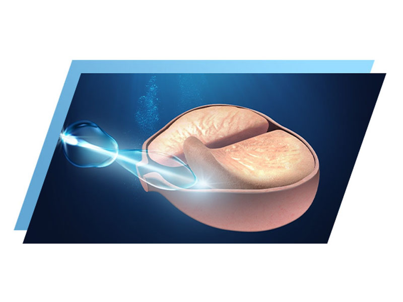 HoLEP laserowa enukleacja prostaty laserem holmowym Bielsko Biała